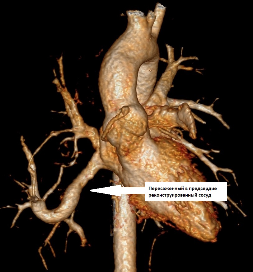 Синдром турецкой сабли. После операции.jpg Синдром турецкой сабли. После операции.jpg